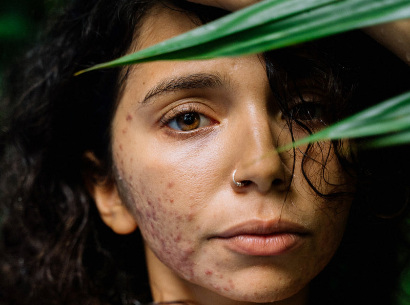 Eating to Reduce Acne: Healthy Pores Are More than Skin Deep