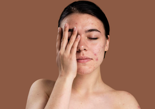 PCOS/PMOS and Your Skin: What Elevated Androgens Can Mean for Acne, Hair Growth, and Hair Thinning