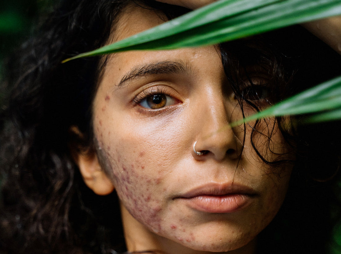 Eating to Reduce Acne: Healthy Pores Are More than Skin Deep